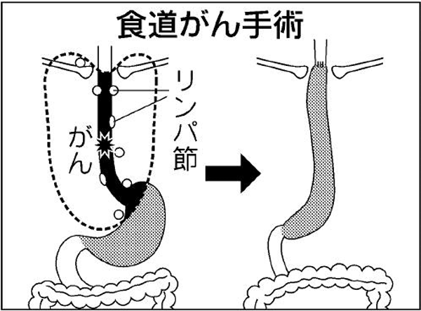 食道がん手術