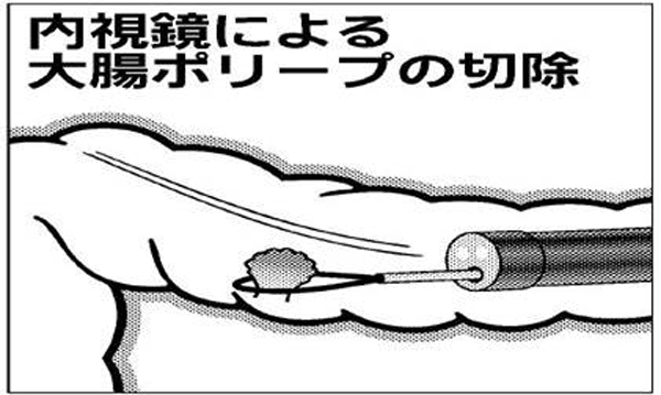 内視鏡による大腸ポリープの切除